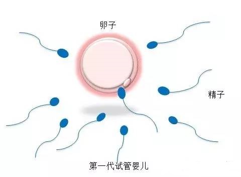 第三代试管婴儿 PGT